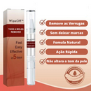 WipeOff™ Removedor de Verrugas |COMPRE 2 LEVE 3| + Frete Grátis